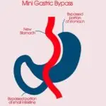 Gastric Bypass Surgery