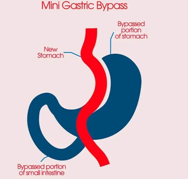 Gastric Bypass Surgery